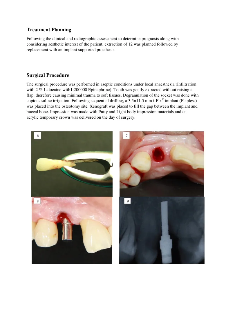 Immediate implant placement and immediate loading with a 3.5 × 11.5 mm i-Fix implant in the aesthetic zone — page preview