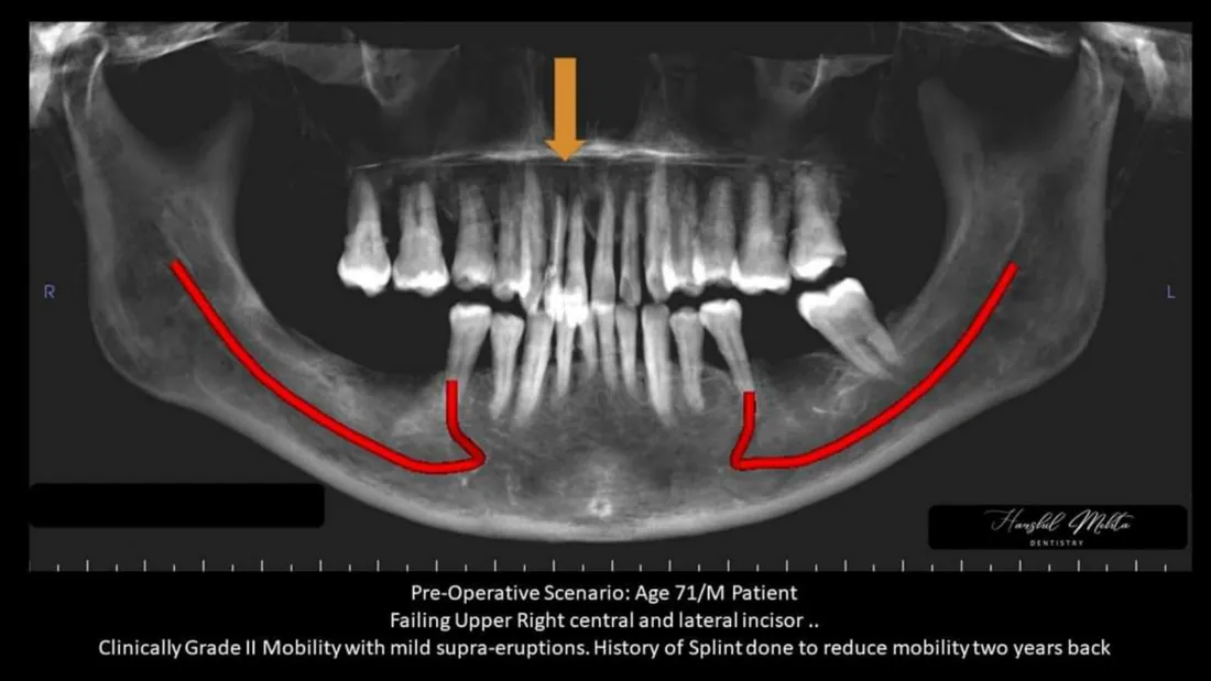 Restoring with implants in the aesthetic zone — page preview