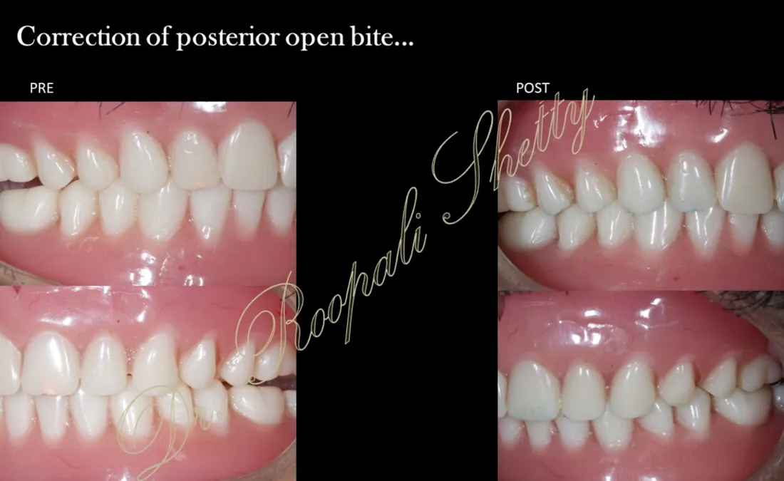 Full mouth rehabilitation with implants — page preview