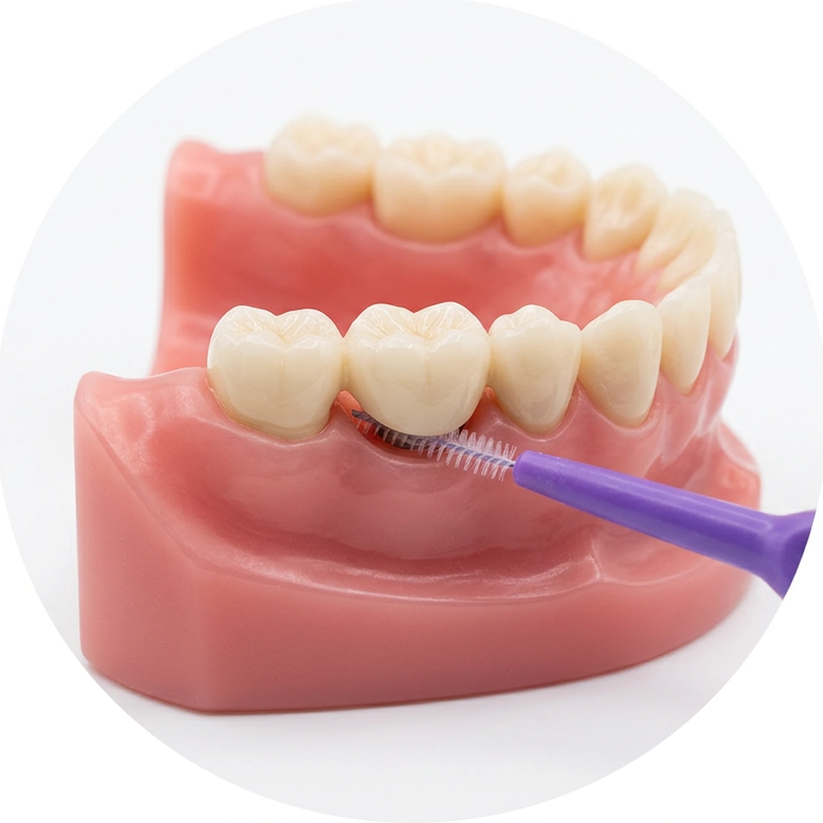 An implant-supported bridge or full-arch prosthesis with an interdental cleaning aid passed beneath it at the tissue-prosthesis interface