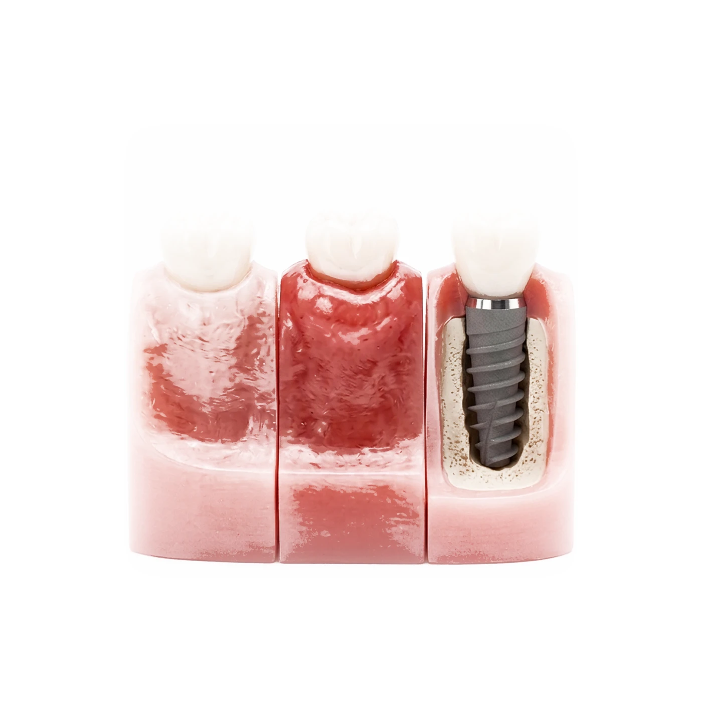 Gum-tissue models of increasing thickness, with a cross-section revealing the implant and crown margin beneath the tallest one