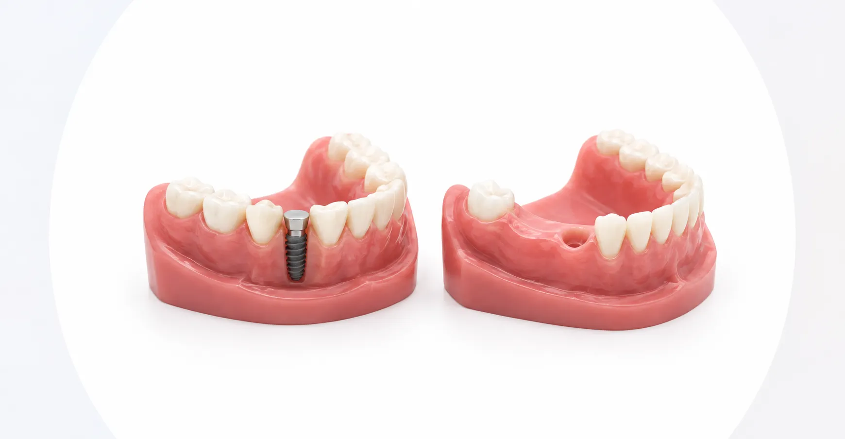 Side-by-side comparison of a fresh extraction socket with an implant placed immediately, and a socket left to heal for delayed placement