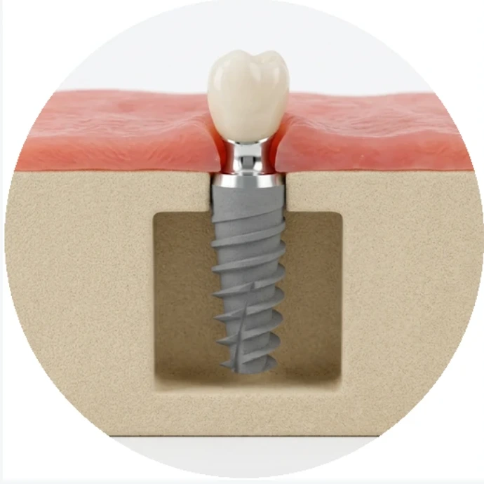 Cross-section of a placed implant and its restoration seated in bone, with the surrounding soft tissue shown