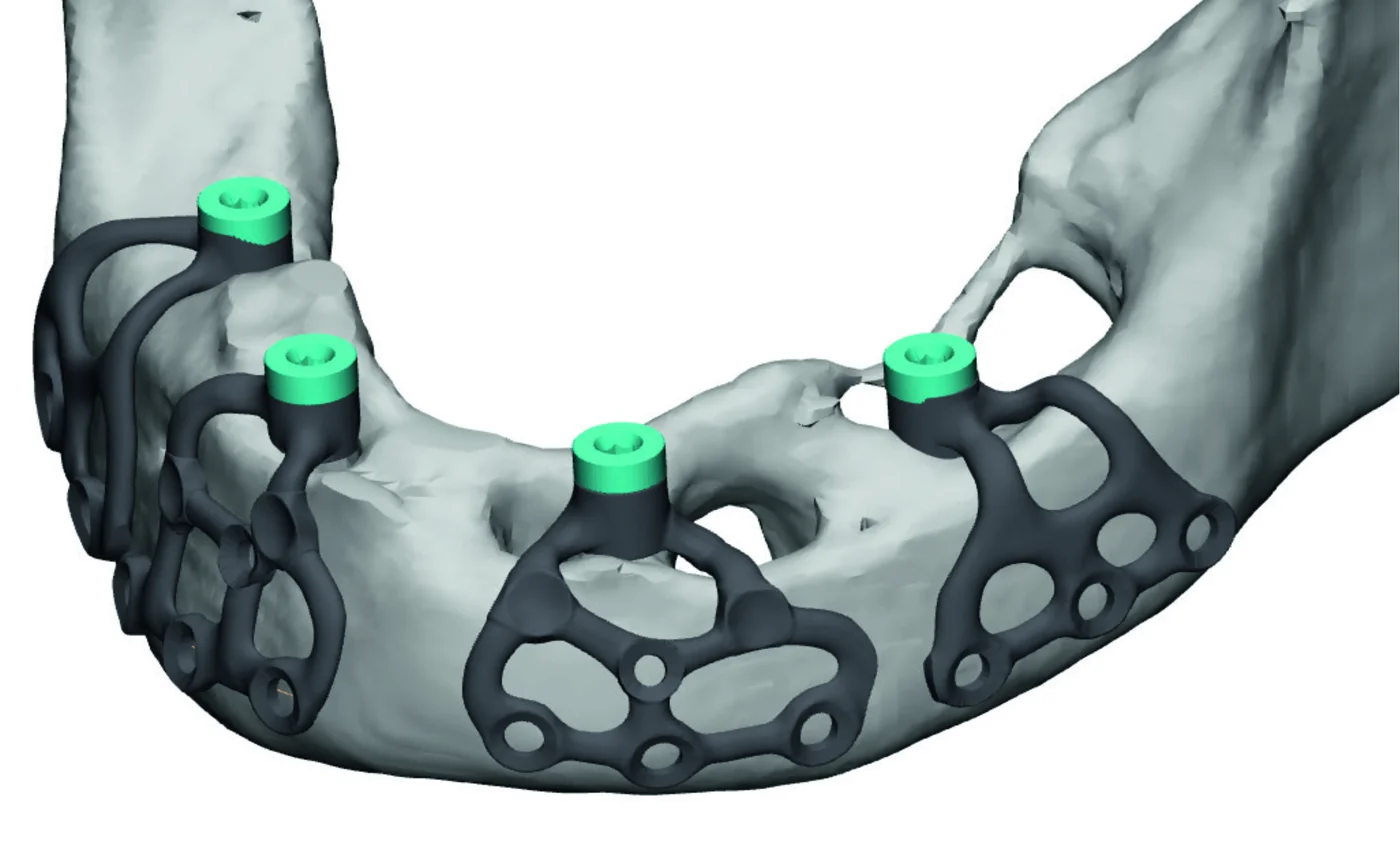 Full-arch mandibular PSI frame with multi-unit abutment interfaces positioned per case.